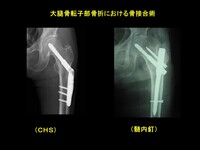 大腿骨近位部骨折 Osteosynthesis & Arthroplasty 大腿骨近位部骨折の治療｜整形外科｜千船病院【大阪市】